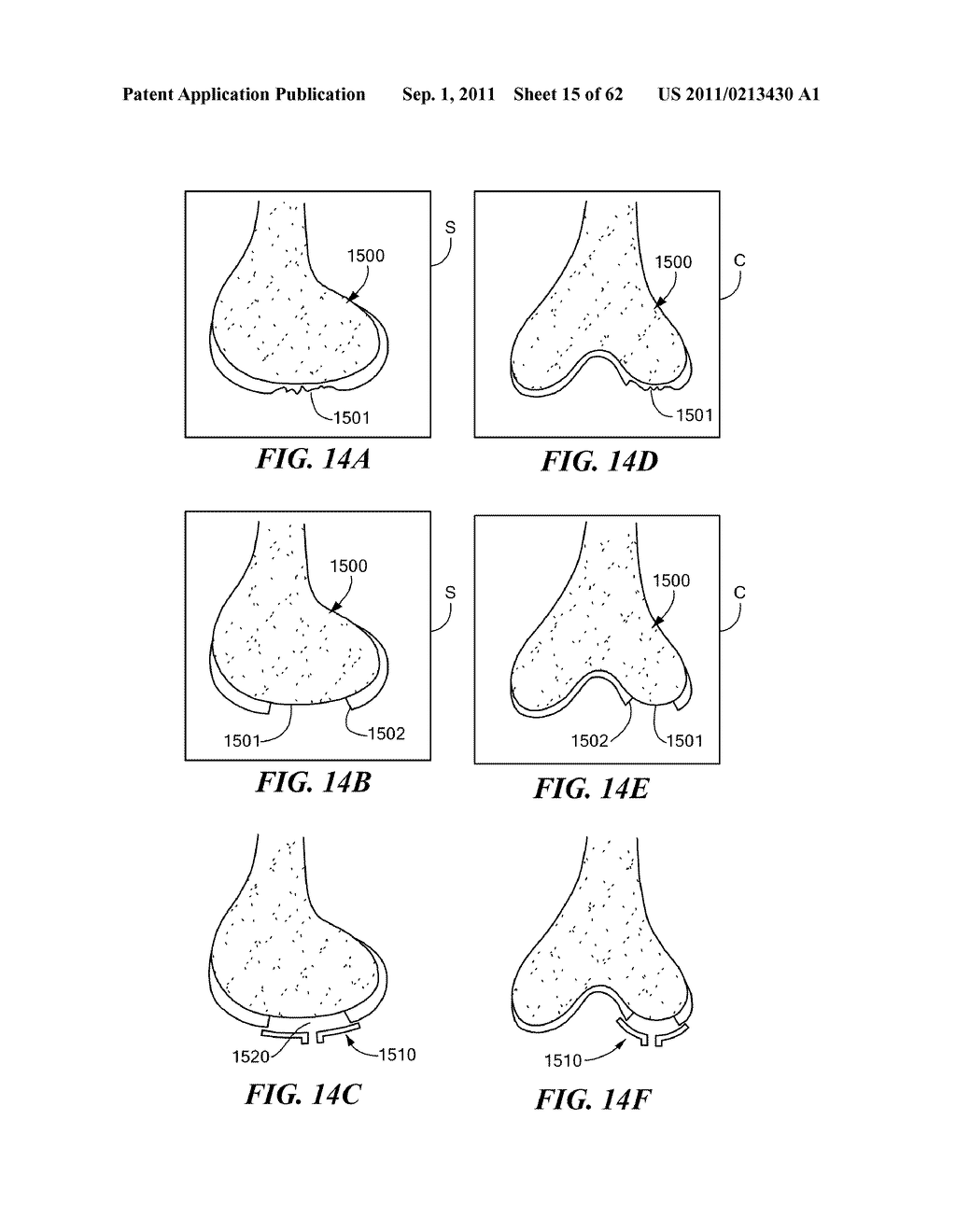 Patient Selectable Joint Arthroplasty Devices and Surgical Tools - diagram, schematic, and image 16