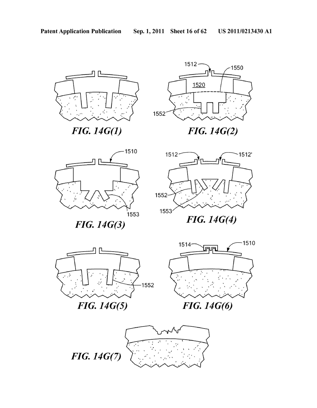 Patient Selectable Joint Arthroplasty Devices and Surgical Tools - diagram, schematic, and image 17