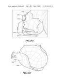 Patient Selectable Joint Arthroplasty Devices and Surgical Tools diagram and image