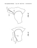 Patient Selectable Joint Arthroplasty Devices and Surgical Tools diagram and image