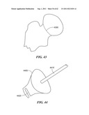 Patient Selectable Joint Arthroplasty Devices and Surgical Tools diagram and image