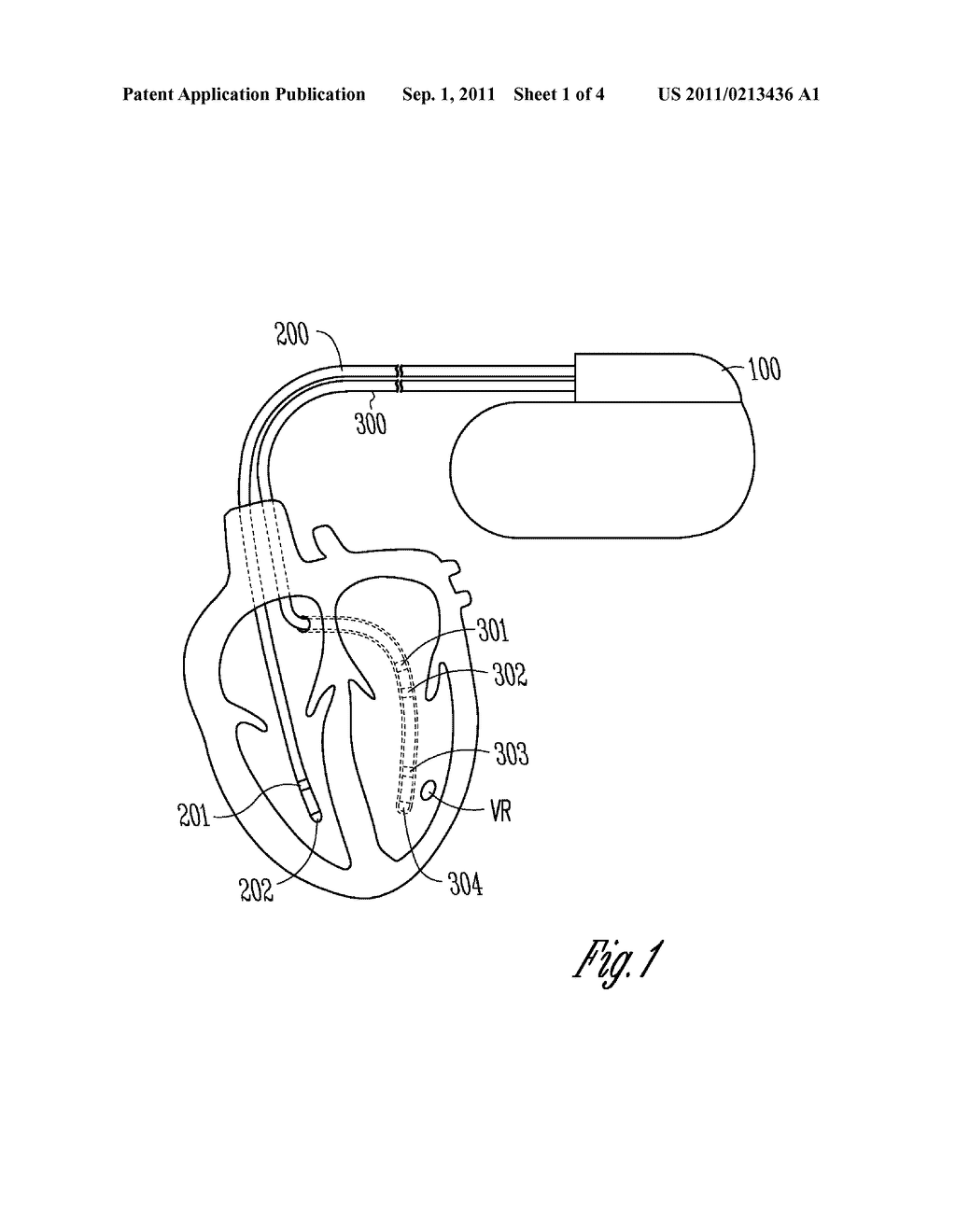 METHOD AND DEVICE FOR TREATING MYOCARDIAL ISCHEMIA - diagram, schematic, and image 02