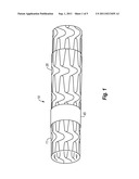 STENT GRAFT diagram and image