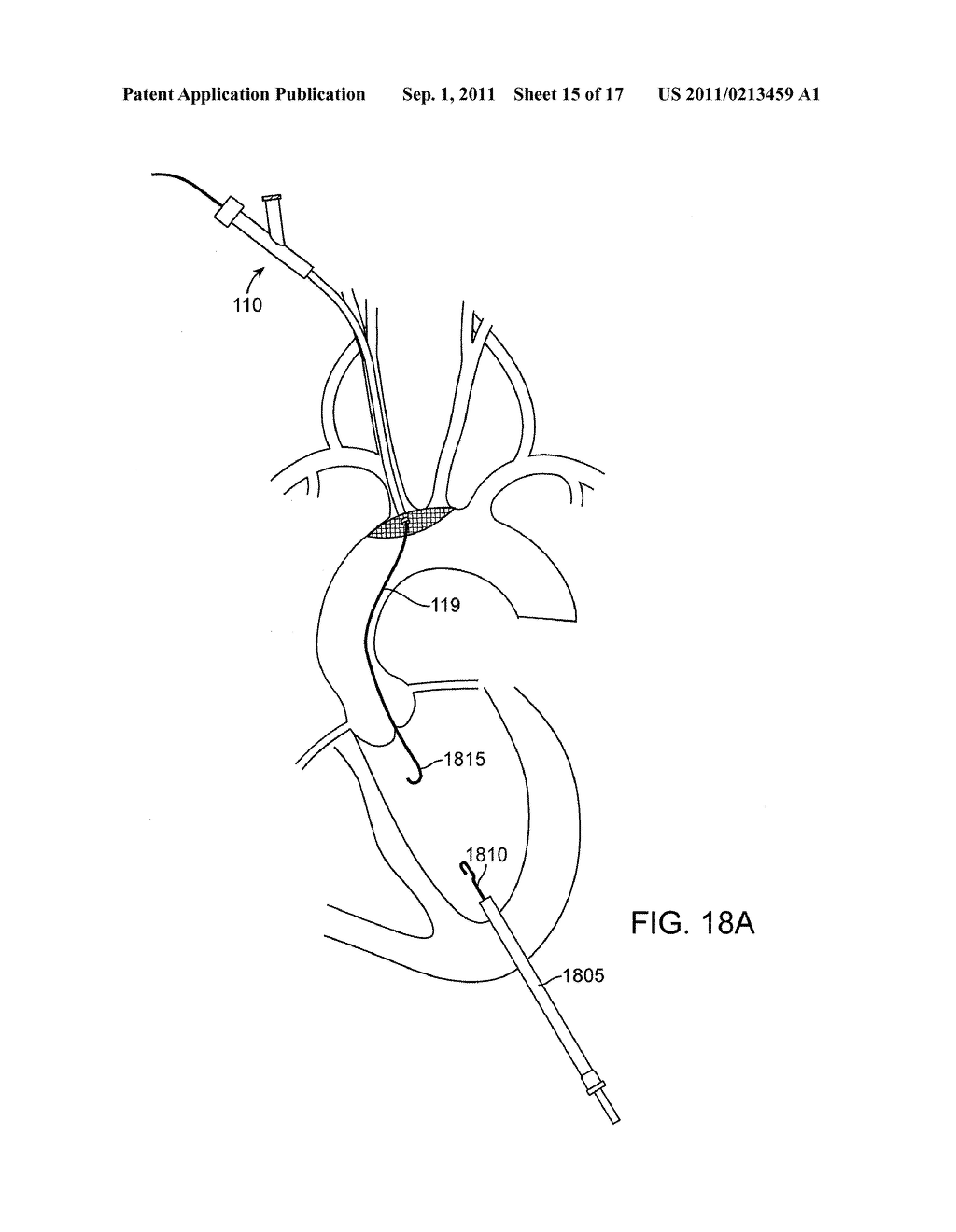 SYSTEMS AND METHODS FOR TRANSCATHETER AORTIC VALVE TREATMENT - diagram, schematic, and image 16