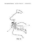 MANDIBULAR MANIPULATOR diagram and image