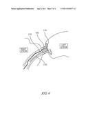 Methods and apparatus for reducing localized circulatory system pressure diagram and image