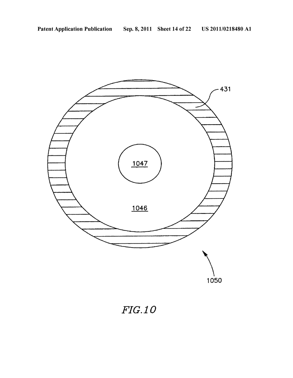 DEVICE AND METHOD FOR CONTROLLING IN-VIVO PRESSURE - diagram, schematic, and image 15