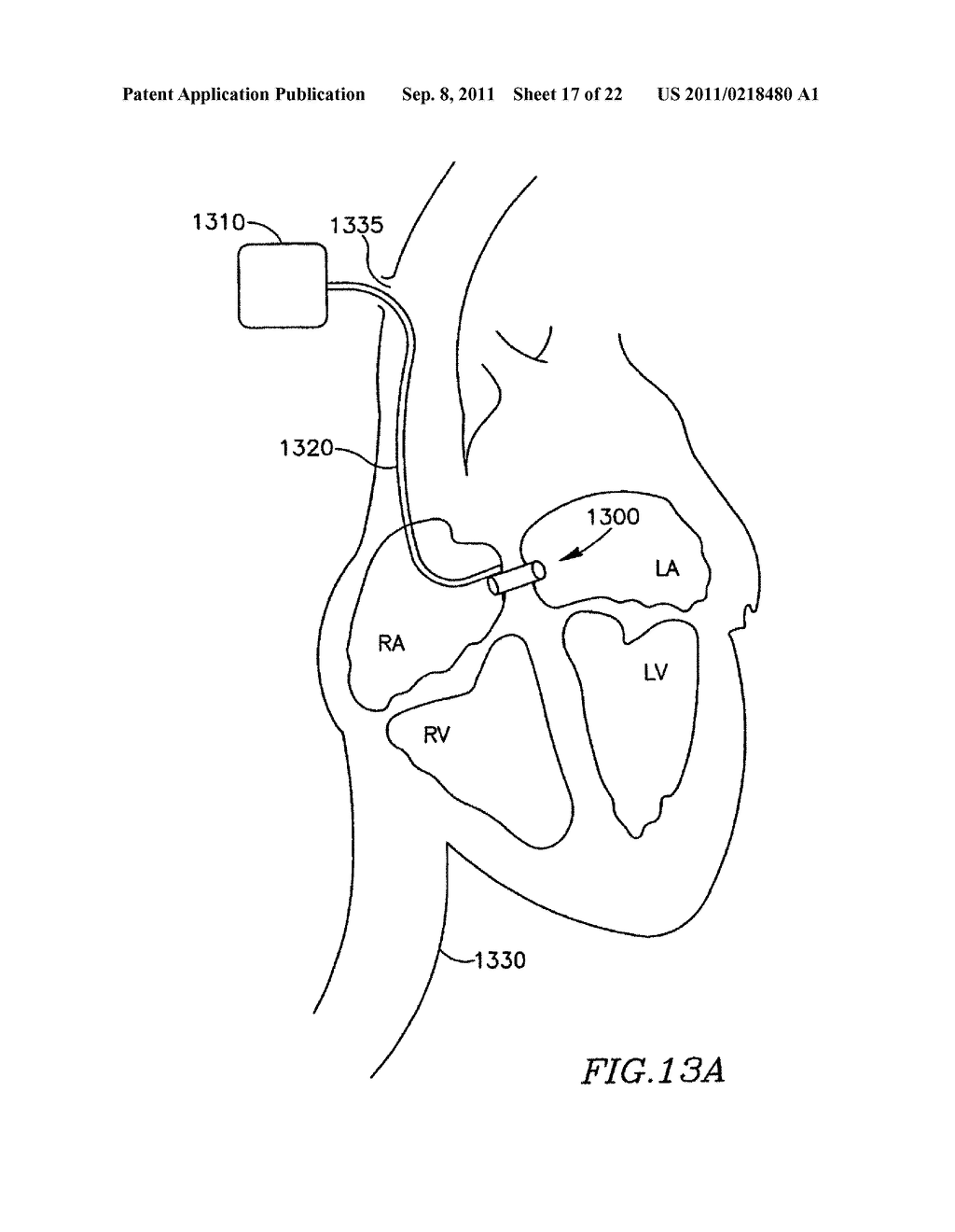 DEVICE AND METHOD FOR CONTROLLING IN-VIVO PRESSURE - diagram, schematic, and image 18