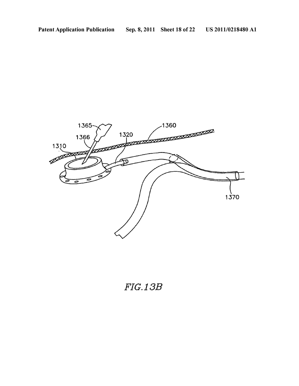DEVICE AND METHOD FOR CONTROLLING IN-VIVO PRESSURE - diagram, schematic, and image 19