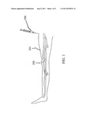 Preparation For Endovenous Laser Ablation diagram and image