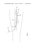 Preparation For Endovenous Laser Ablation diagram and image