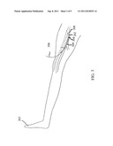 Preparation For Endovenous Laser Ablation diagram and image