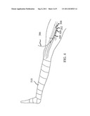 Preparation For Endovenous Laser Ablation diagram and image