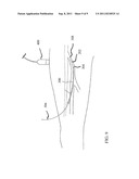 Preparation For Endovenous Laser Ablation diagram and image