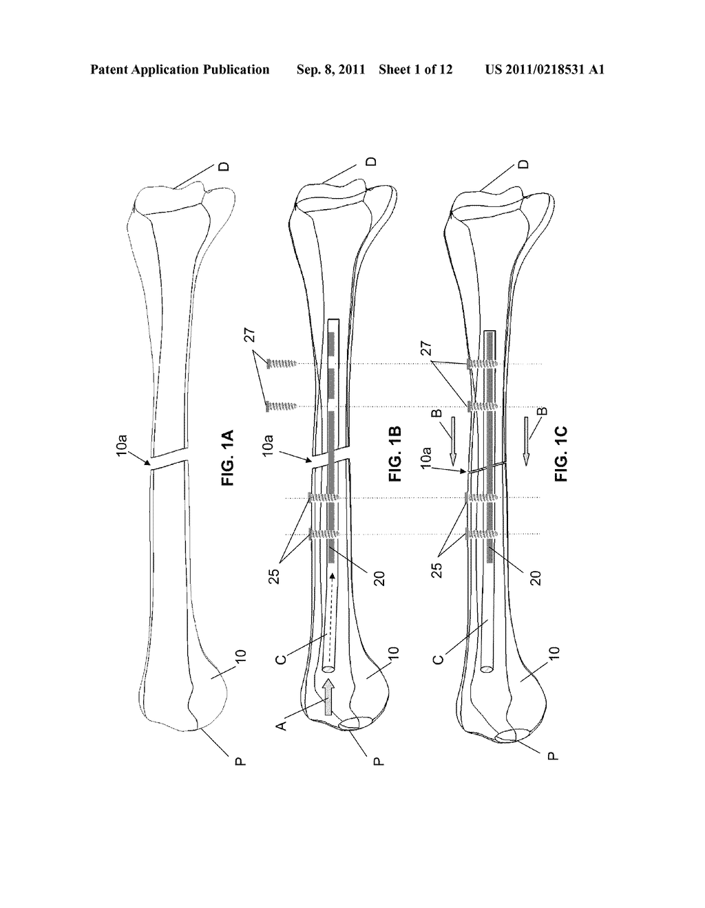 ENDOSTEAL NAIL PLATE FOR FIXING BONE SEGMENTS - diagram, schematic, and image 02