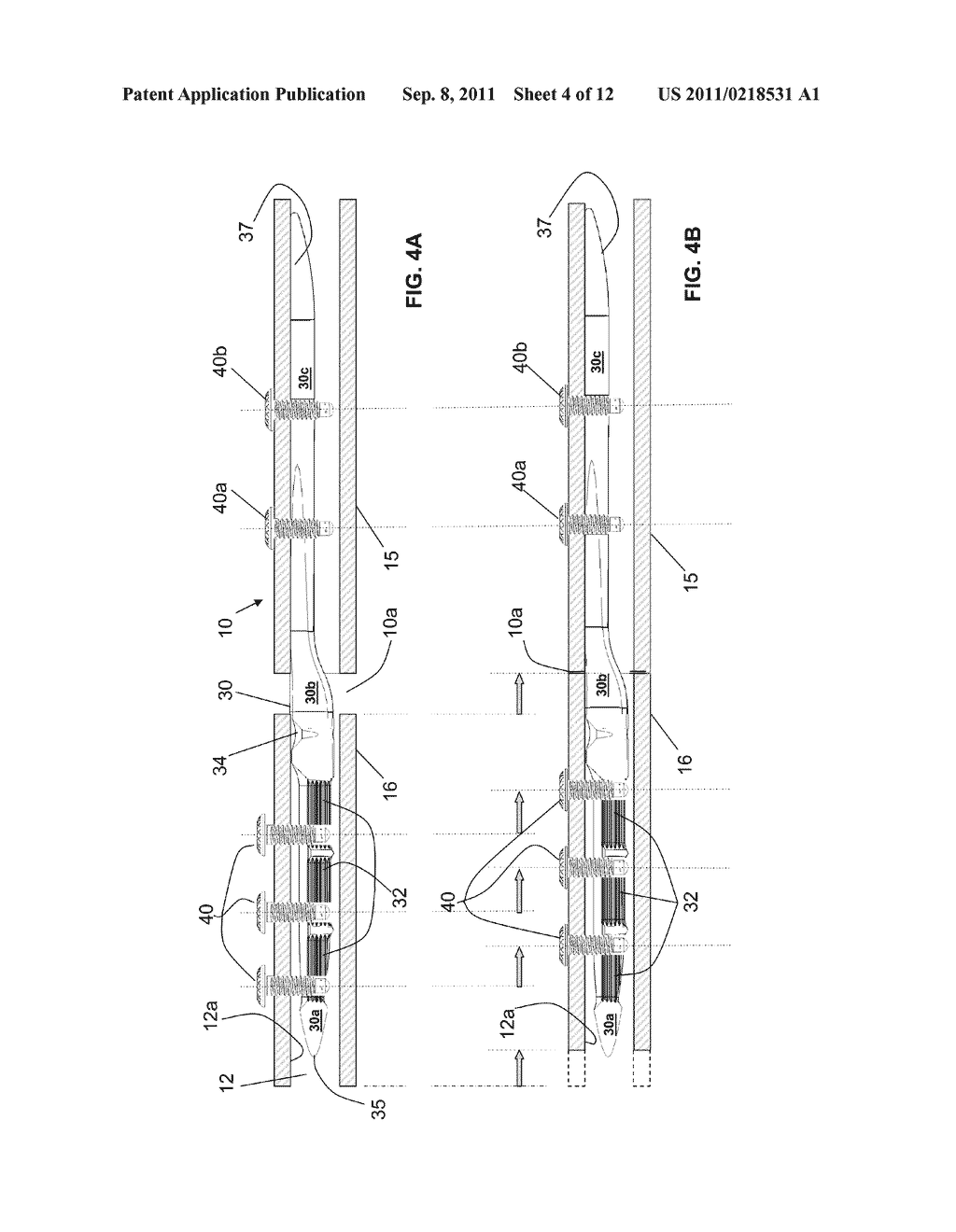 ENDOSTEAL NAIL PLATE FOR FIXING BONE SEGMENTS - diagram, schematic, and image 05