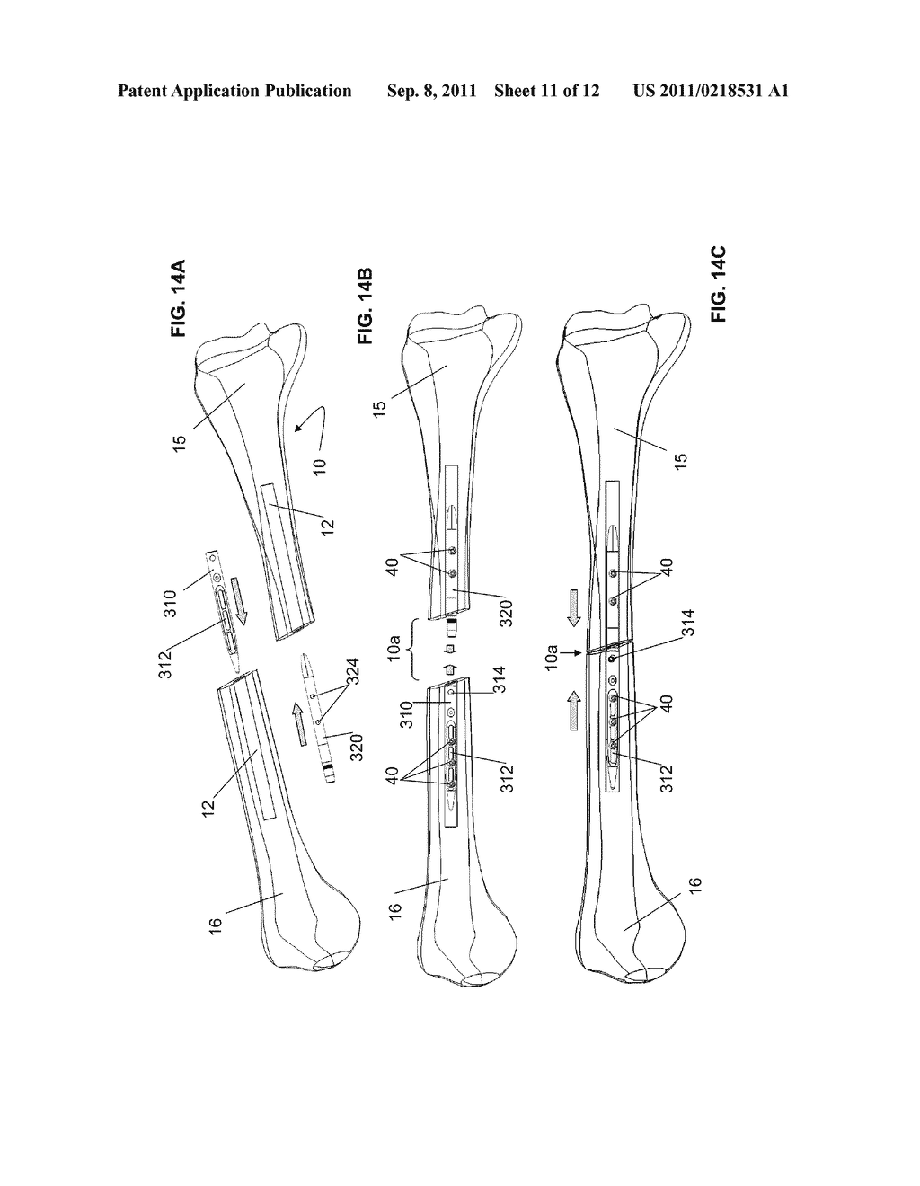 ENDOSTEAL NAIL PLATE FOR FIXING BONE SEGMENTS - diagram, schematic, and image 12