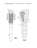 Method and Apparatus for Preparing a Proximal Femur diagram and image