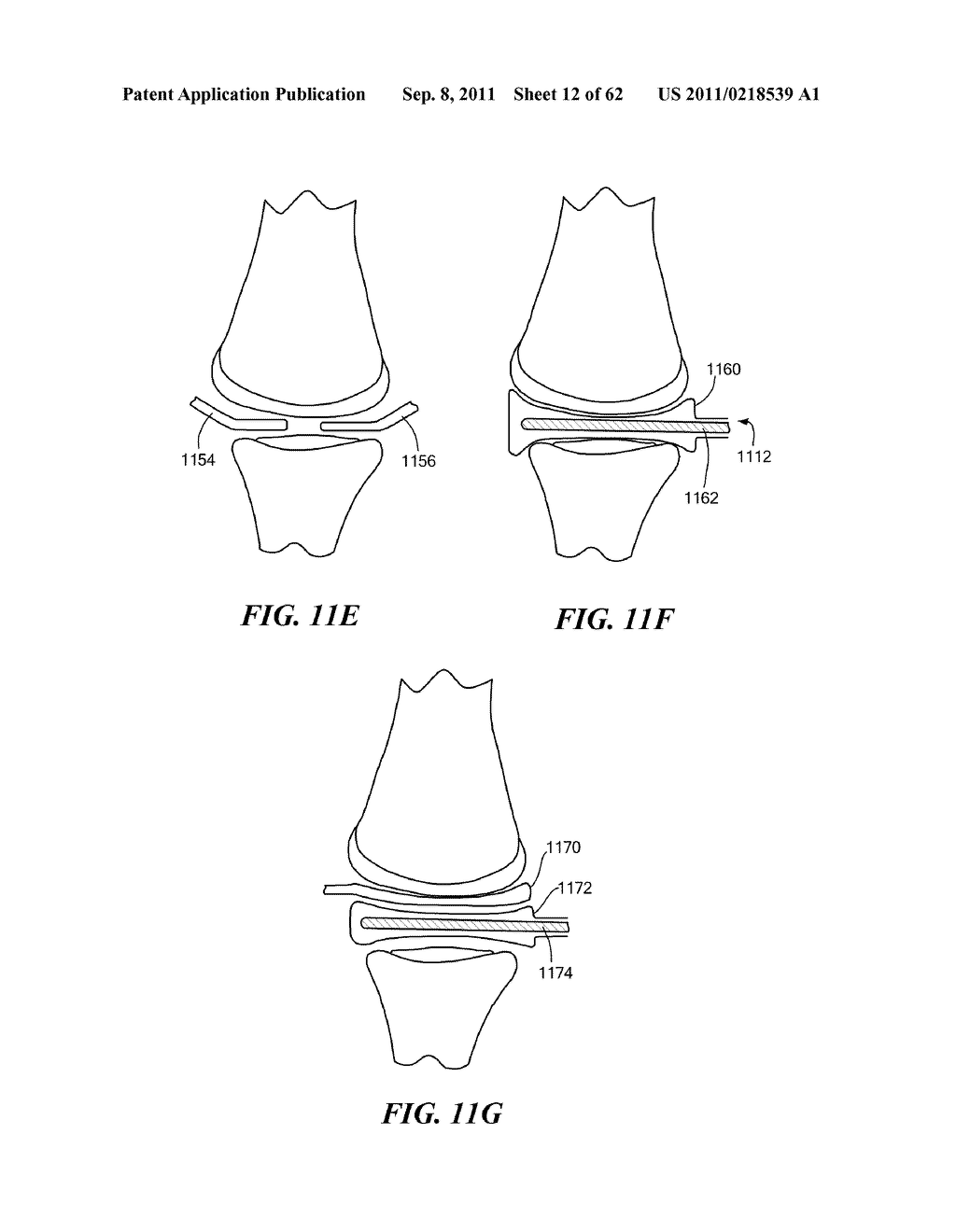 Patient Selectable Joint Arthroplasty Devices and Surgical Tools - diagram, schematic, and image 13