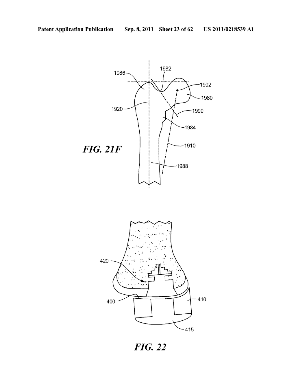 Patient Selectable Joint Arthroplasty Devices and Surgical Tools - diagram, schematic, and image 24