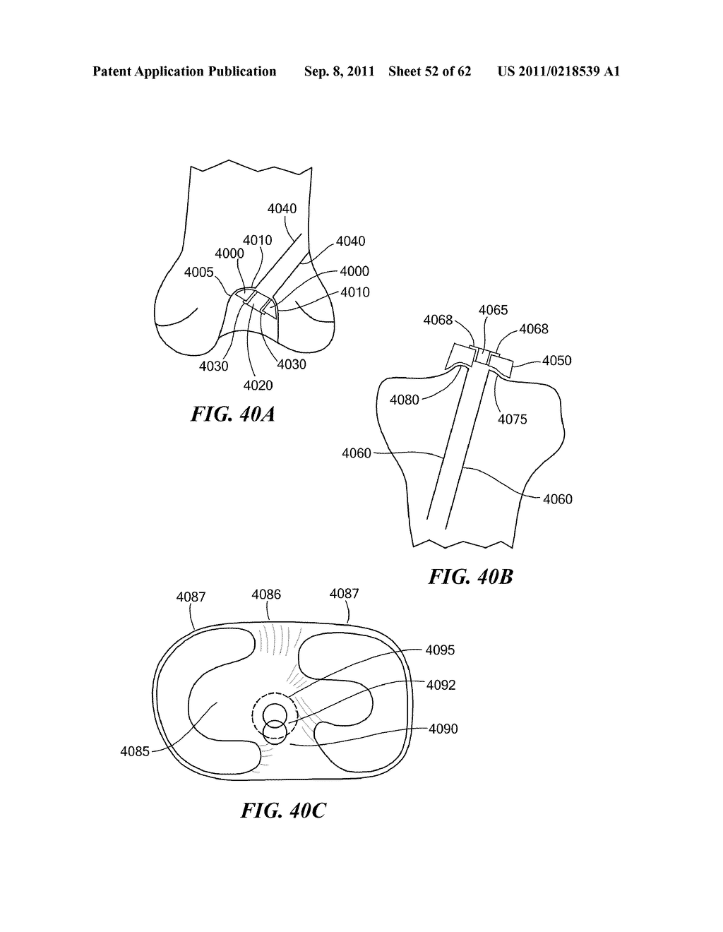 Patient Selectable Joint Arthroplasty Devices and Surgical Tools - diagram, schematic, and image 53