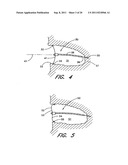 METHOD FOR LEFT ATRIAL APPENDAGE OCCLUSION diagram and image