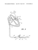 METHOD FOR LEFT ATRIAL APPENDAGE OCCLUSION diagram and image