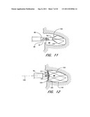 METHOD FOR LEFT ATRIAL APPENDAGE OCCLUSION diagram and image