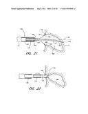 METHOD FOR LEFT ATRIAL APPENDAGE OCCLUSION diagram and image