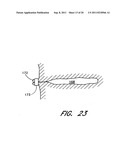 METHOD FOR LEFT ATRIAL APPENDAGE OCCLUSION diagram and image