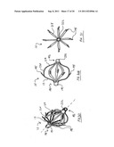 METHOD FOR LEFT ATRIAL APPENDAGE OCCLUSION diagram and image