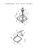 METHOD FOR LEFT ATRIAL APPENDAGE OCCLUSION diagram and image