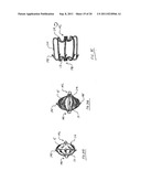 METHOD FOR LEFT ATRIAL APPENDAGE OCCLUSION diagram and image