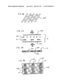 METHOD FOR LEFT ATRIAL APPENDAGE OCCLUSION diagram and image