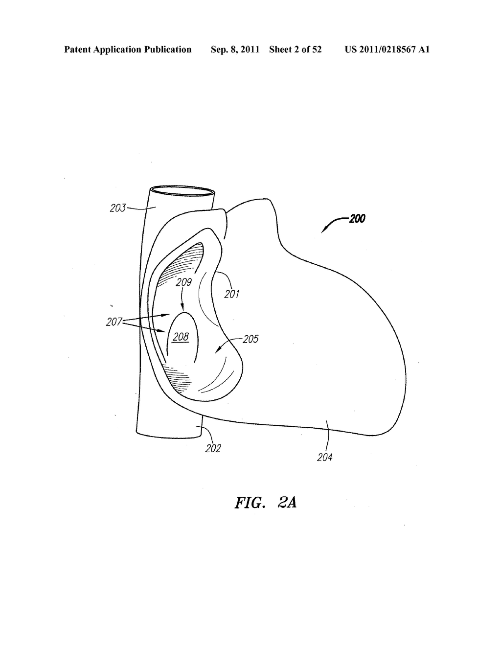 Systems and Methods for Treating Septal Defects - diagram, schematic, and image 03