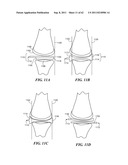 Patient Selectable Joint Arthroplasty Devices and Surgical Tools diagram and image