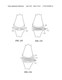 Patient Selectable Joint Arthroplasty Devices and Surgical Tools diagram and image