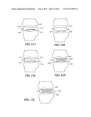 Patient Selectable Joint Arthroplasty Devices and Surgical Tools diagram and image