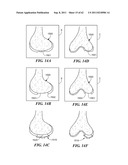 Patient Selectable Joint Arthroplasty Devices and Surgical Tools diagram and image