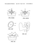 Patient Selectable Joint Arthroplasty Devices and Surgical Tools diagram and image