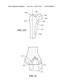 Patient Selectable Joint Arthroplasty Devices and Surgical Tools diagram and image