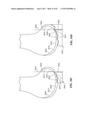 Patient Selectable Joint Arthroplasty Devices and Surgical Tools diagram and image