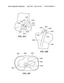 Patient Selectable Joint Arthroplasty Devices and Surgical Tools diagram and image