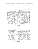 Vascular Prosthesis Assembly with Retention Mechanism and Method diagram and image