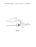 Vascular Prosthesis Assembly with Retention Mechanism and Method diagram and image