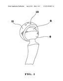 Interlocking reverse hip prosthesis diagram and image