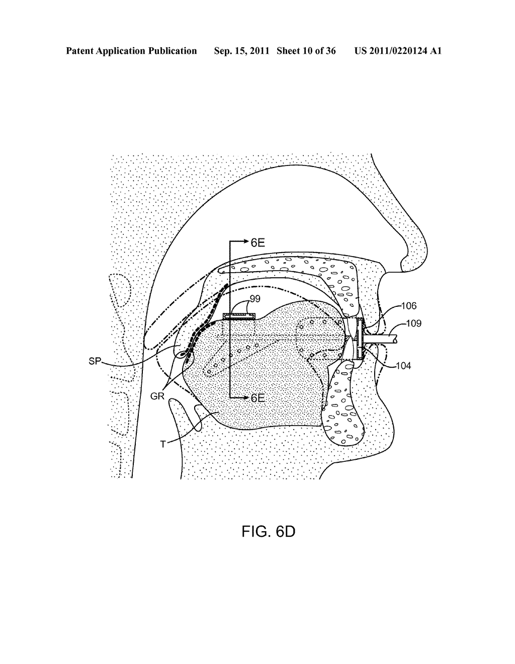 METHODS AND SYSTEMS FOR IMPROVING AIRWAY PATENCY - diagram, schematic, and image 11