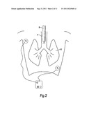 Intubation monitoring apparatus and method diagram and image