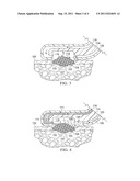 Tissue Debridement Systems and Methods diagram and image