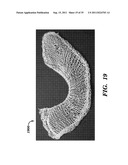 PROSTHETIC DEVICE HAVING DIAGONAL YARNS AND METHOD OF MANUFACTURING THE     SAME diagram and image